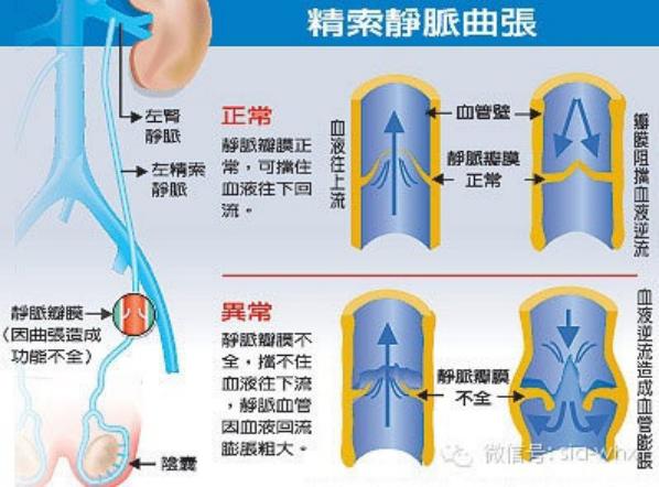 關(guān)于2021年征兵精索靜脈曲張標(biāo)準(zhǔn)的探討，2021年征兵精索靜脈曲張標(biāo)準(zhǔn)深度解析