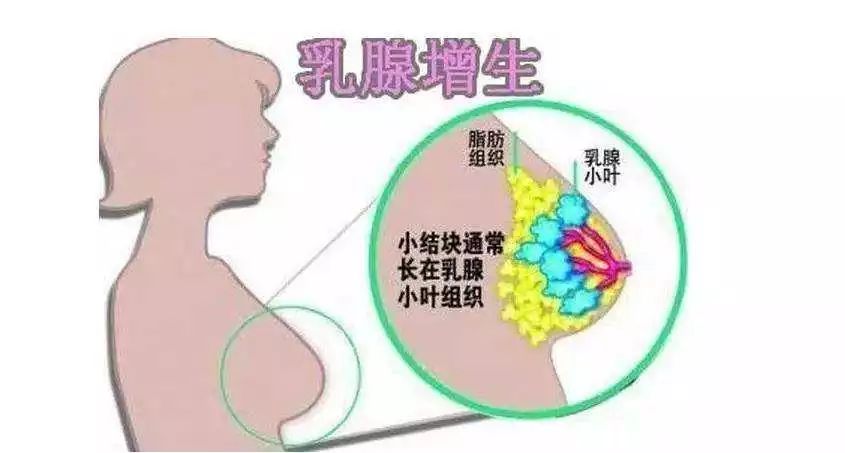 乳腺增生常做四個動作，預(yù)防與緩解的關(guān)鍵，乳腺增生預(yù)防與緩解的關(guān)鍵，四個動作助你健康護理