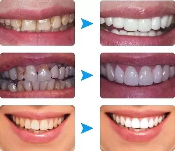 牙齒洗白要多少錢？全面解析牙齒美白費用因素，牙齒美白費用全解析，牙齒洗白需要多少錢？