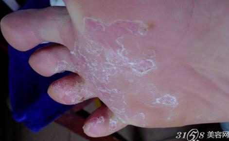 腳脫皮怎么辦？藥物治療推薦與護理建議，腳脫皮解決方法，藥物治療推薦及護理建議