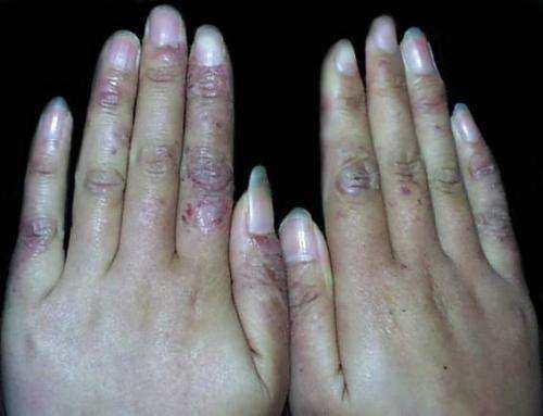 根治凍瘡，預(yù)防復(fù)發(fā)，全面解析凍瘡的治療方法，根治凍瘡，預(yù)防復(fù)發(fā)，全面解析凍瘡治療策略