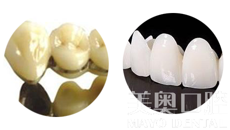 烤瓷牙和全瓷牙的利與弊，深度解析，深度解析，烤瓷牙與全瓷牙的優(yōu)缺點(diǎn)對(duì)比