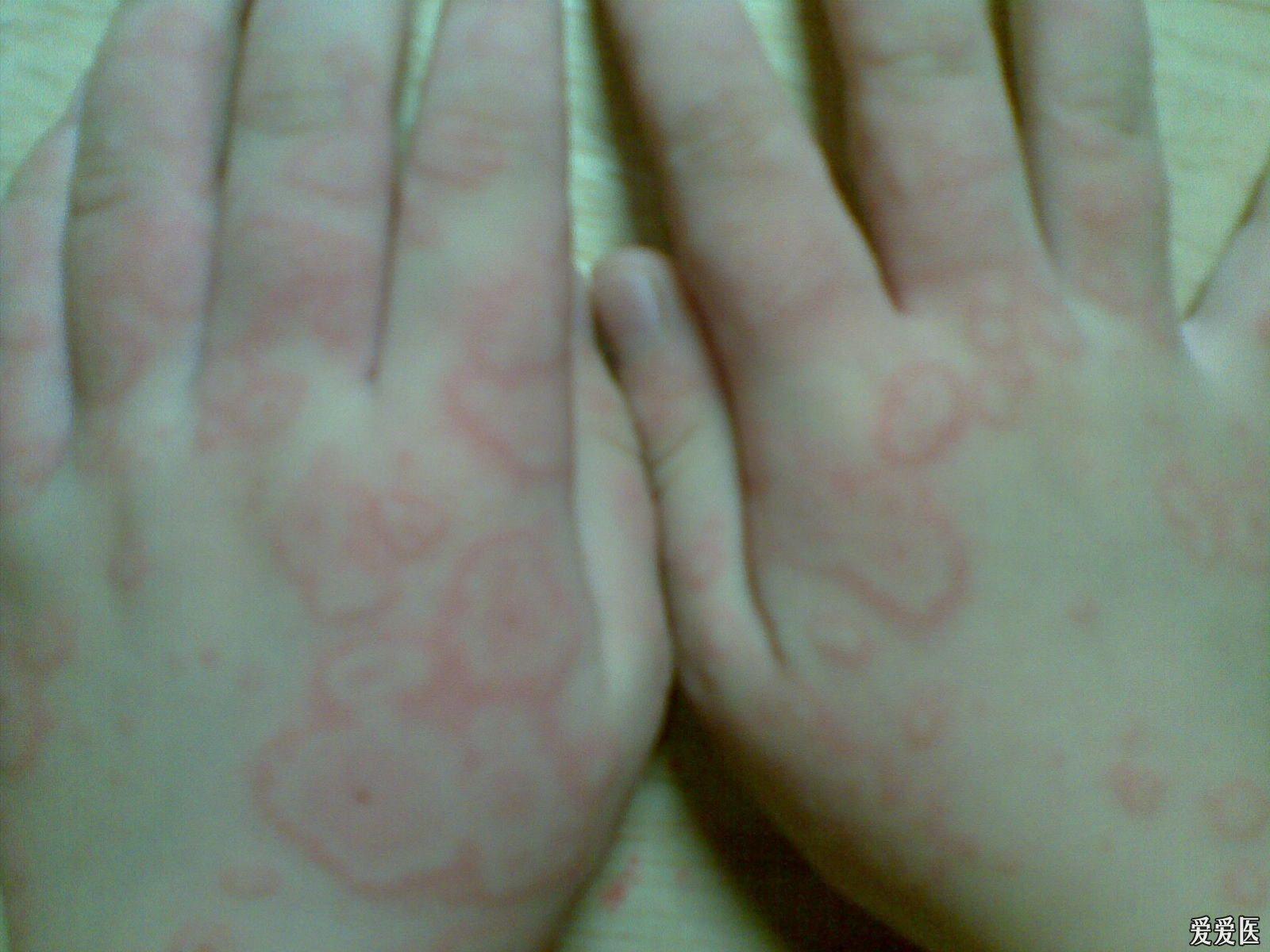 關(guān)于螨蟲過敏圖片與澳彩資料的查詢，來自94848.cσm的詳盡資源，螨蟲過敏圖片與澳彩資料查詢，詳盡資源來自94848.cσm