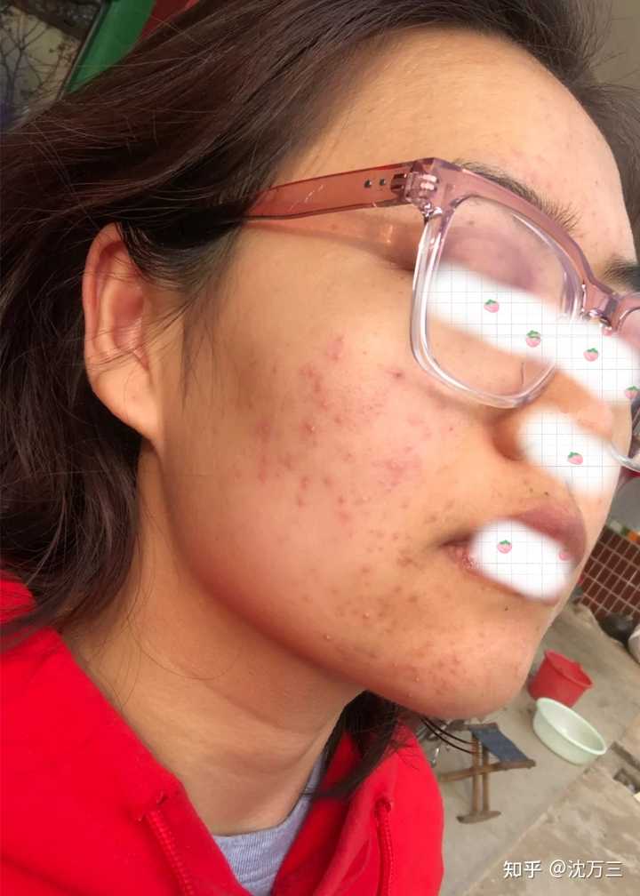 消除痤瘡留下的紅色痘印的有效方法，消除紅色痘印，痤瘡后的護(hù)膚秘訣