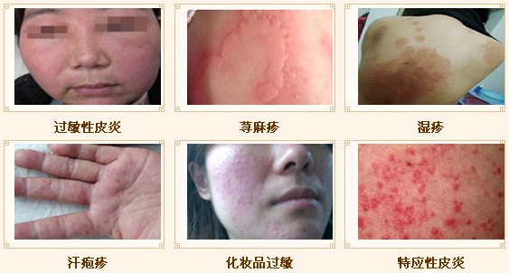 過(guò)敏性皮炎治愈方法，全面解析與應(yīng)對(duì)策略，過(guò)敏性皮炎全面解析，治愈方法與應(yīng)對(duì)策略