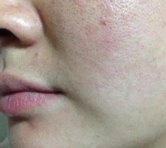 臉上毛孔粗大怎么辦？全方位解決方案助你擁有細膩肌膚，全方位解決毛孔粗大難題，讓你擁有細膩肌膚的秘訣！