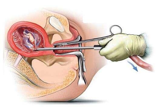 流產(chǎn)最小的傷害是哪一種，探討不同流產(chǎn)方式的利弊與選擇策略，探討不同流產(chǎn)方式的利弊，尋找最小傷害的選擇策略
