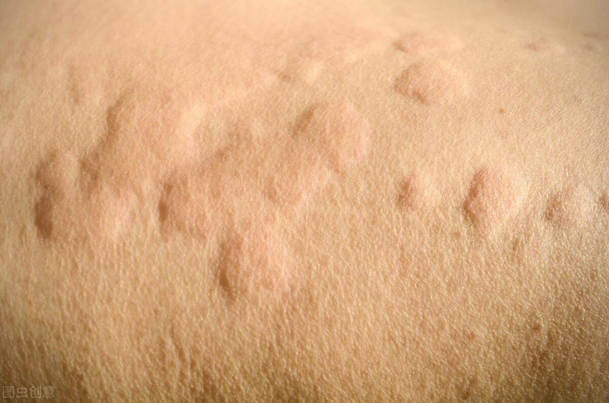 熱性蕁麻疹，成因、癥狀與應(yīng)對策略，熱性蕁麻疹，成因、癥狀及應(yīng)對之策