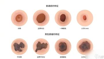 正常痣與黑色素瘤圖片，了解二者的區(qū)別與識別方法，正常痣與黑色素瘤圖片對比，區(qū)分與識別方法指南