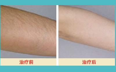 激光脫毛的價(jià)格解析，多少錢才能擁有絲滑肌膚？，激光脫毛價(jià)格詳解，多少錢能擁有絲滑肌膚？