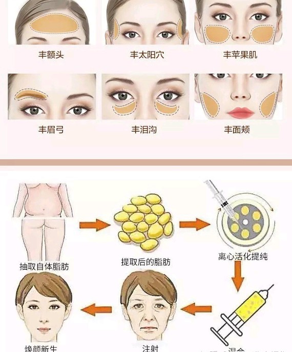 自體脂肪填充后最忌諱的幾個(gè)注意事項(xiàng)，自體脂肪填充后的關(guān)鍵注意事項(xiàng)與忌諱事項(xiàng)清單