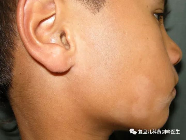 白色糠疹，了解、預(yù)防與治療，白色糠疹，全面解析、預(yù)防與治療方法