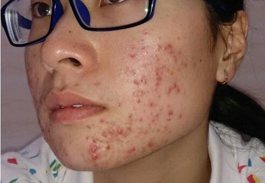 如何去除青春痘，男生的護(hù)膚指南，男生護(hù)膚指南，如何有效去除青春痘