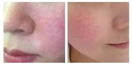 臉頰紅血絲如何修復，全面解析與實用建議，臉頰紅血絲全面解析與修復實用建議